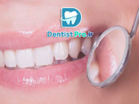 روکش دندان جلو برای اصلاح لبخند طبیعی