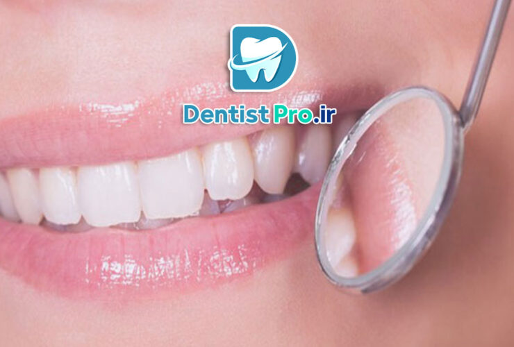 روکش دندان جلو برای اصلاح لبخند طبیعی