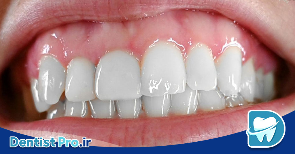 ترمیم لبخند لثه ای با جراحی لثه و لمینت 26 ترمیم لبخند لثه ای با جراحی لثه و لمینت