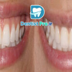 ترمیم لبخند لثه ای با جراحی لثه و لمینت