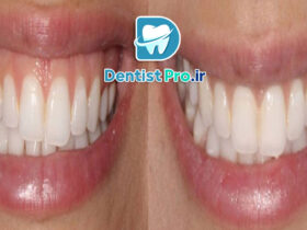 ترمیم لبخند لثه ای با جراحی لثه و لمینت