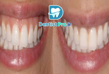 ترمیم لبخند لثه ای با جراحی لثه و لمینت