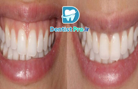 ترمیم لبخند لثه ای با جراحی لثه و لمینت