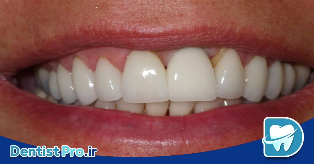 ایمپلنت فوری دندان جلو با ظاهر کاملا طبیعی 26 ایمپلنت فوری دندان جلو با ظاهر کاملا طبیعی