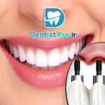 ایمپلنت فوری دندان جلو با ظاهر کاملا طبیعی