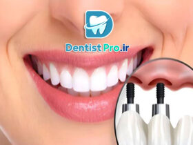 ایمپلنت فوری دندان جلو با ظاهر کاملا طبیعی