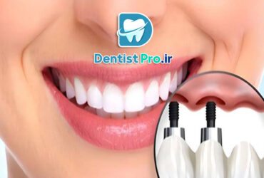 ایمپلنت فوری دندان جلو با ظاهر کاملا طبیعی