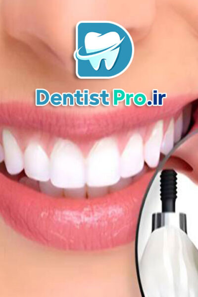 ایمپلنت فوری دندان جلو با ظاهر کاملا طبیعی