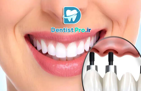 ایمپلنت فوری دندان جلو با ظاهر کاملا طبیعی