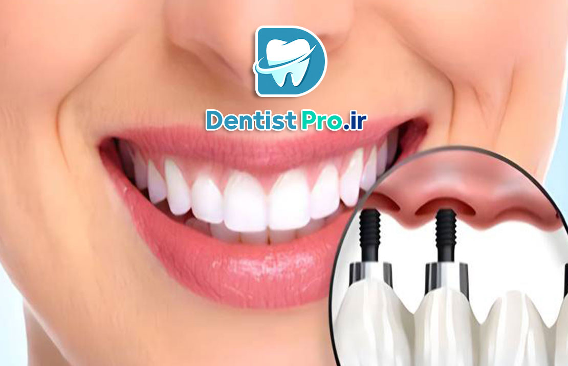 ایمپلنت فوری دندان جلو با ظاهر کاملا طبیعی 25 ایمپلنت فوری دندان جلو با ظاهر کاملا طبیعی