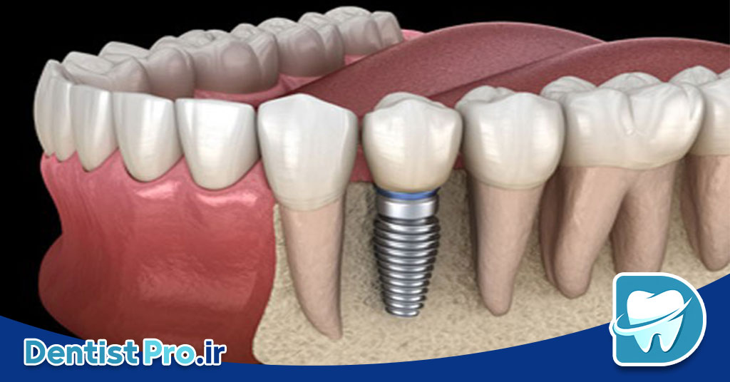 کاشت ایمپلنت فوری بعد از کشیدن دندان جلو