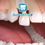 کاشت ایمپلنت فوری بعد از کشیدن دندان جلو