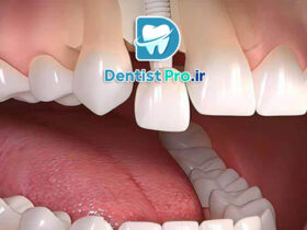 کاشت ایمپلنت فوری بعد از کشیدن دندان جلو