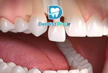 کاشت ایمپلنت فوری بعد از کشیدن دندان جلو