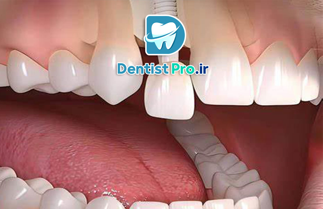 کاشت ایمپلنت فوری بعد از کشیدن دندان جلو