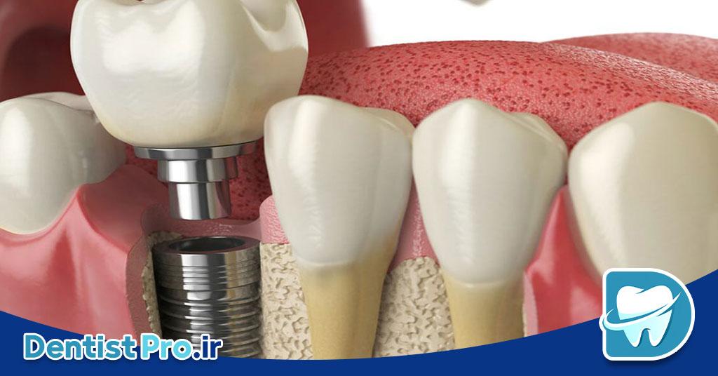 ایمپلنت برای فضای کم بین دندانی
