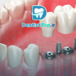 ایمپلنت برای فضای کم بین دندانی