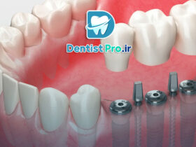 ایمپلنت برای فضای کم بین دندانی