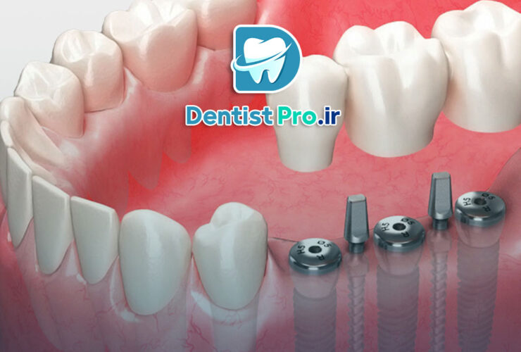 ایمپلنت برای فضای کم بین دندانی