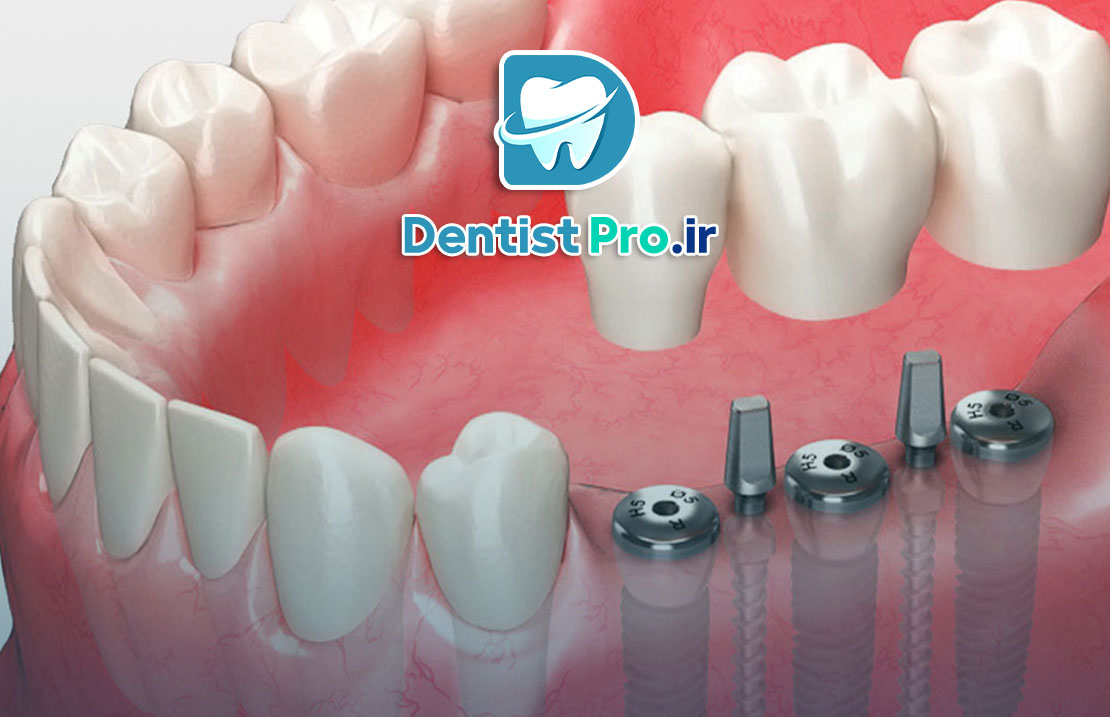 ایمپلنت برای فضای کم بین دندانی