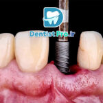 ایمپلنت مناسب بیماران دیابتی کنترل شده