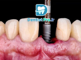 ایمپلنت مناسب بیماران دیابتی کنترل شده