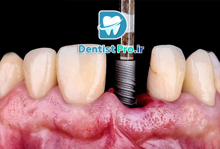 ایمپلنت مناسب بیماران دیابتی کنترل شده