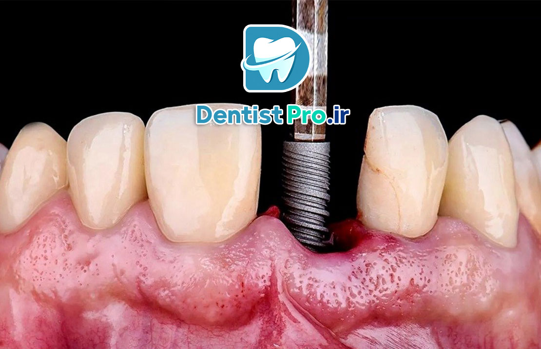 ایمپلنت مناسب بیماران دیابتی کنترل شده