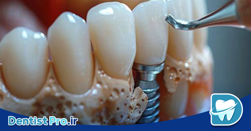 ایمپلنت با PRF برای ترمیم سریع لثه