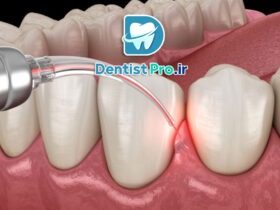 ایمپلنت با PRF برای ترمیم سریع لثه