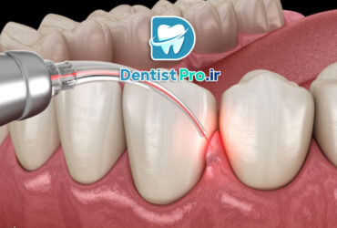 ایمپلنت با PRF برای ترمیم سریع لثه