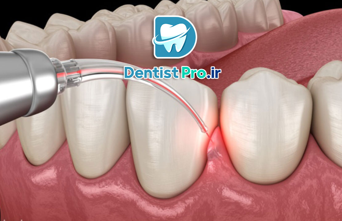 ایمپلنت با PRF برای ترمیم سریع لثه