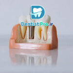 ایمپلنت با حداقل برش و خونریزی