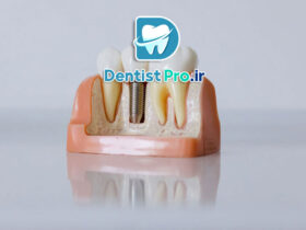 ایمپلنت با حداقل برش و خونریزی