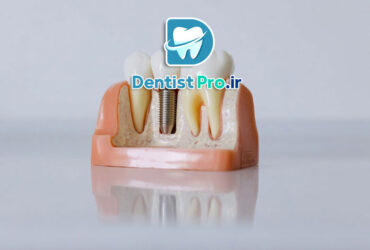 ایمپلنت با حداقل برش و خونریزی