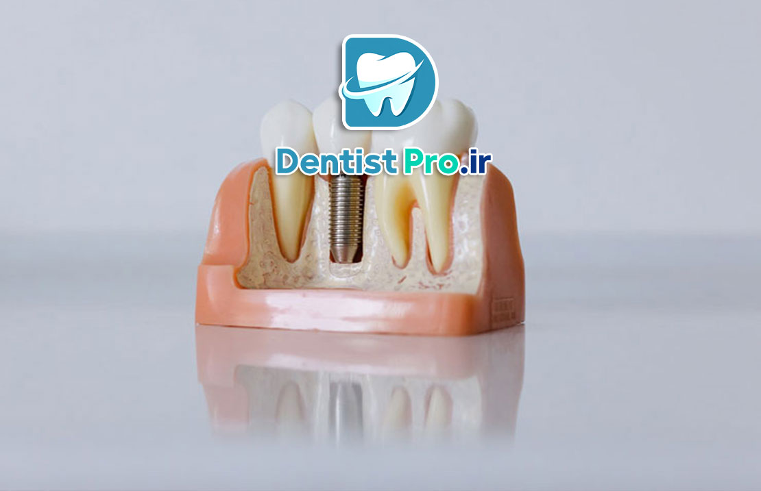 ایمپلنت با حداقل برش و خونریزی