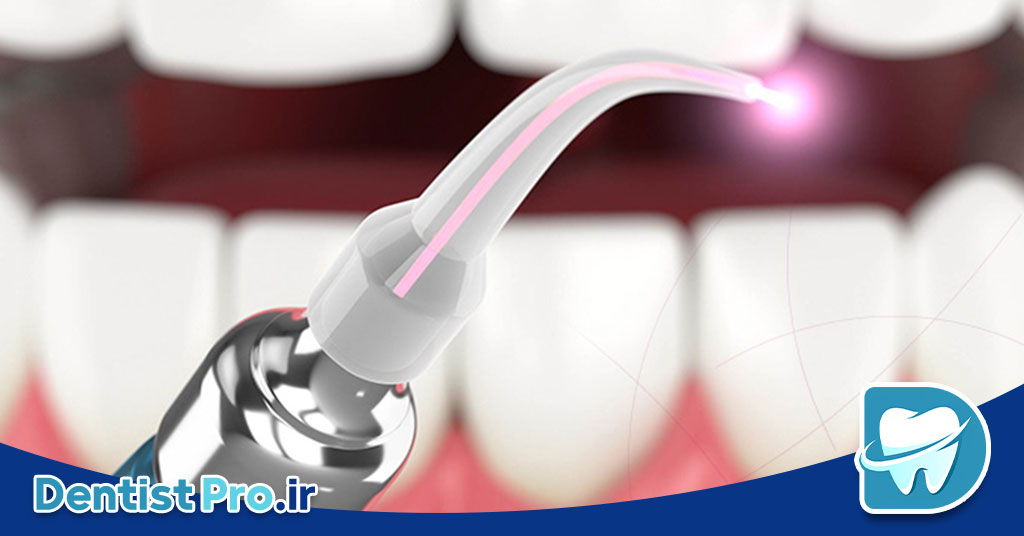 ایمپلنت با حداقل برش و خونریزی