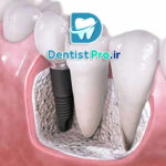 بازسازی استخوان فک برای کاشت ایمپلنت