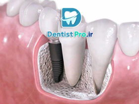 بازسازی استخوان فک برای کاشت ایمپلنت