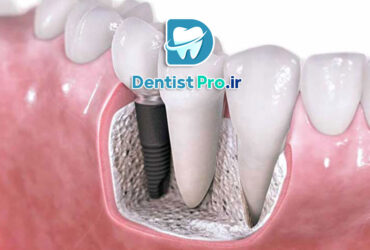 بازسازی استخوان فک برای کاشت ایمپلنت