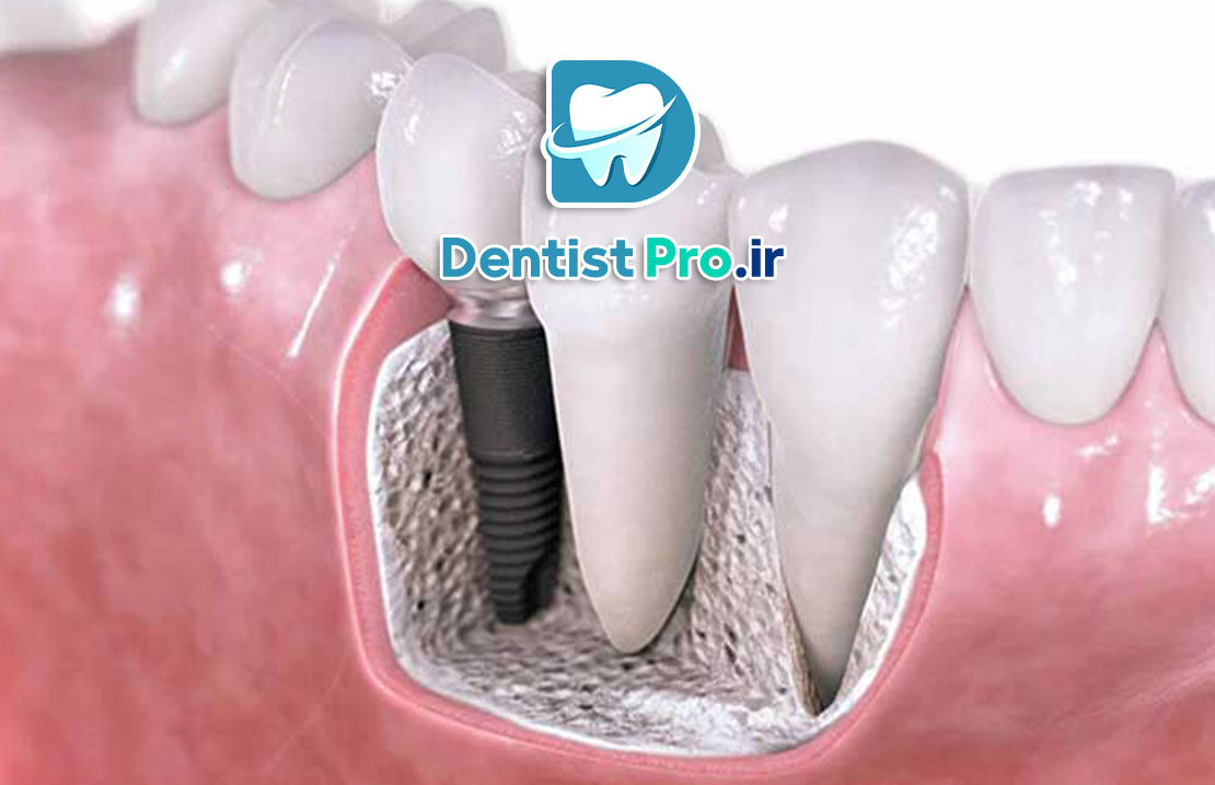 بازسازی استخوان فک برای کاشت ایمپلنت 25 بازسازی استخوان فک برای کاشت ایمپلنت