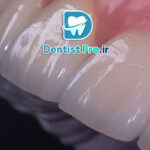 لمینت برای دندان های کوچک یا کوتاه