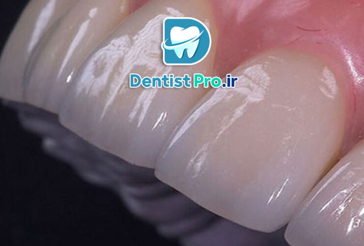 لمینت برای دندان های کوچک یا کوتاه