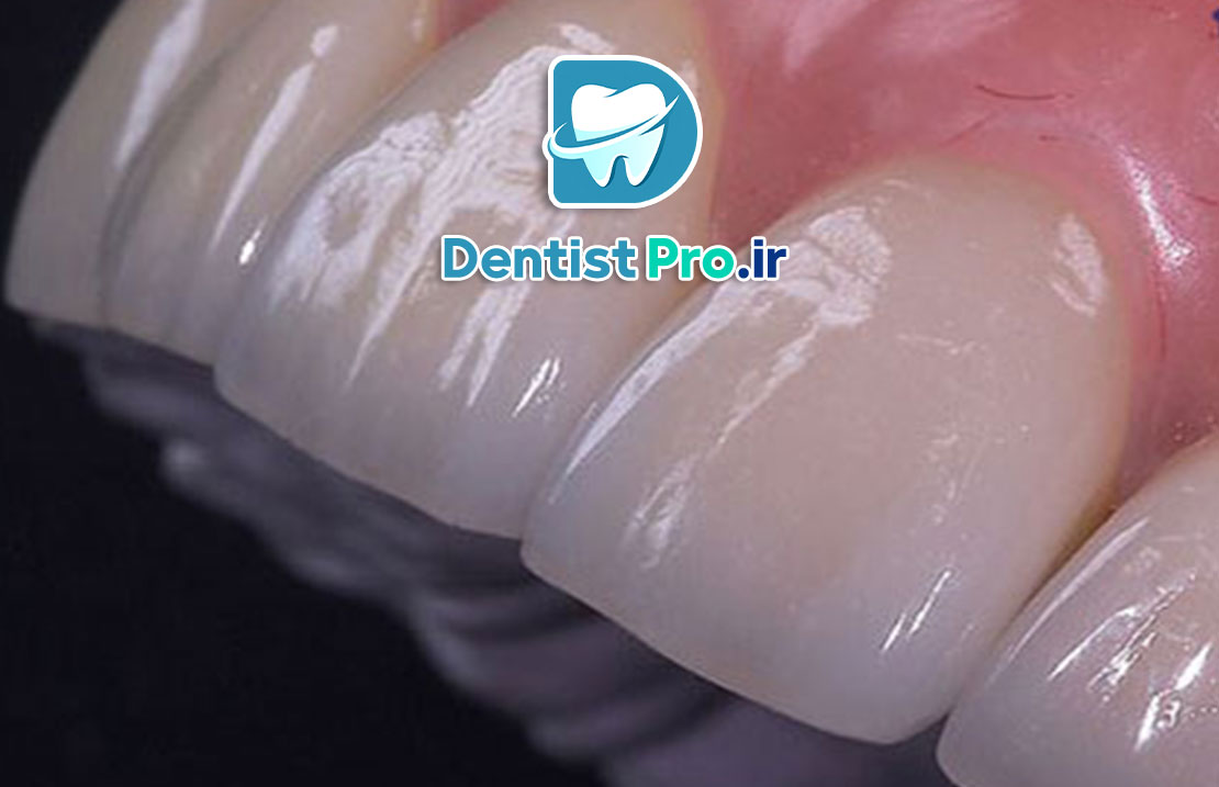 لمینت برای دندان های کوچک یا کوتاه