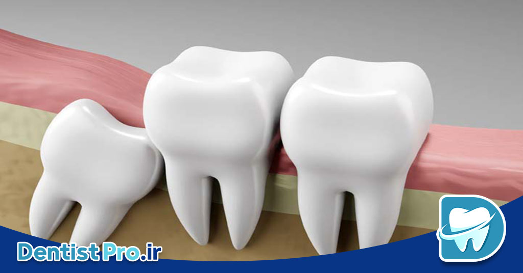 جراحی دندان عقل نهفته به روش لیزری بدون خونریزی 26 جراحی دندان عقل نهفته به روش لیزری بدون خونریزی