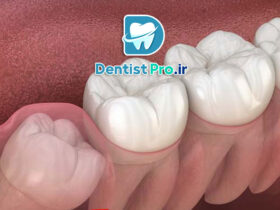 جراحی دندان عقل نهفته به روش لیزری بدون خونریزی