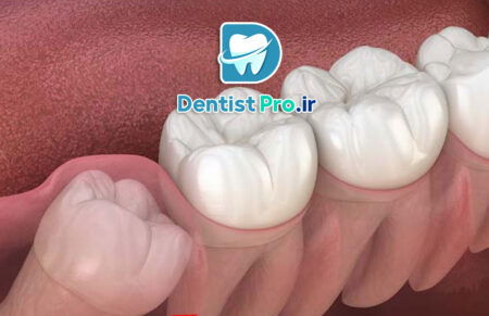 جراحی دندان عقل نهفته به روش لیزری بدون خونریزی