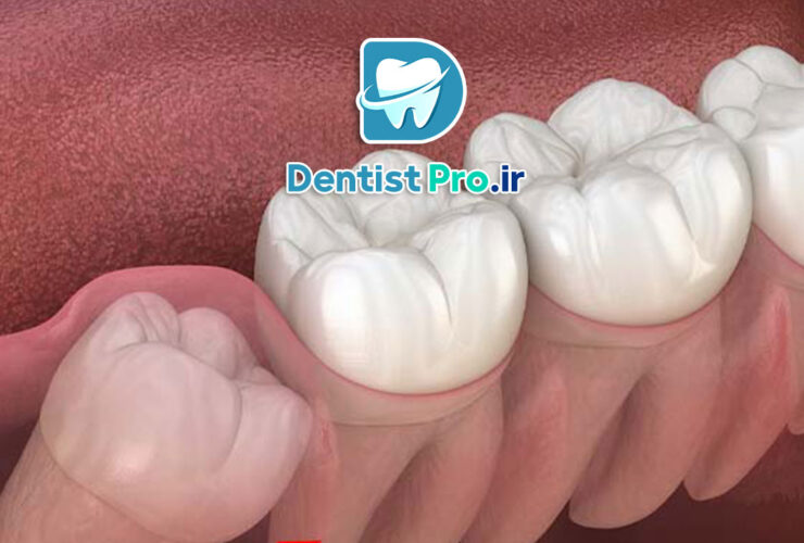 جراحی دندان عقل نهفته به روش لیزری بدون خونریزی 31 جراحی دندان عقل نهفته به روش لیزری بدون خونریزی