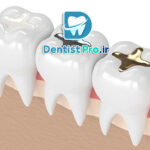 پر کردن دندان با ظاهری طبیعی و همرنگ