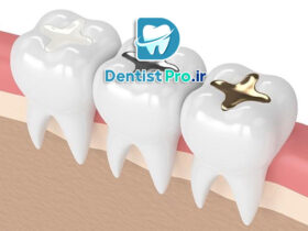 پر کردن دندان با ظاهری طبیعی و همرنگ